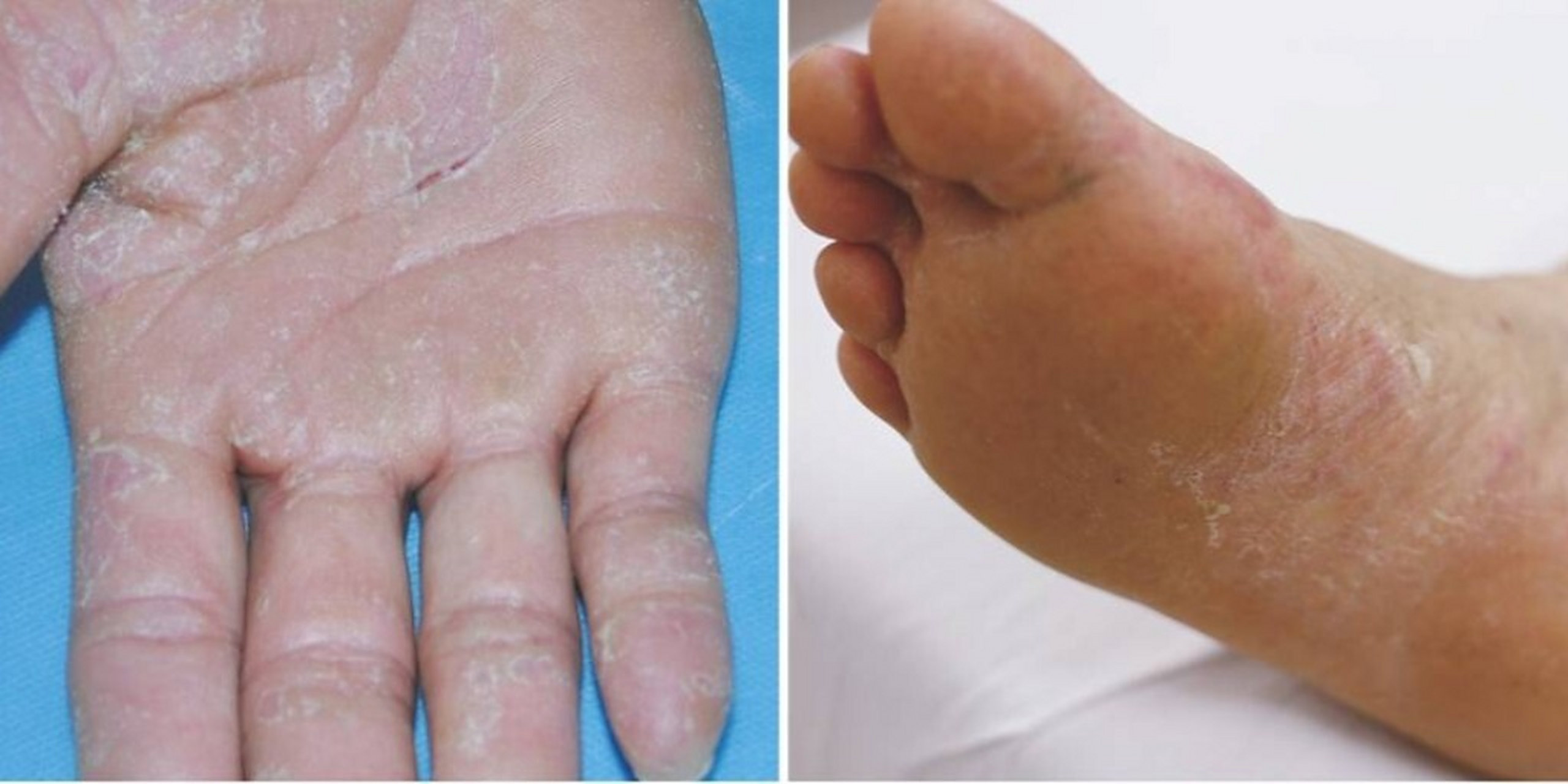 皮肤病之手足癣 症状解读 手足癣可分为以下三型.