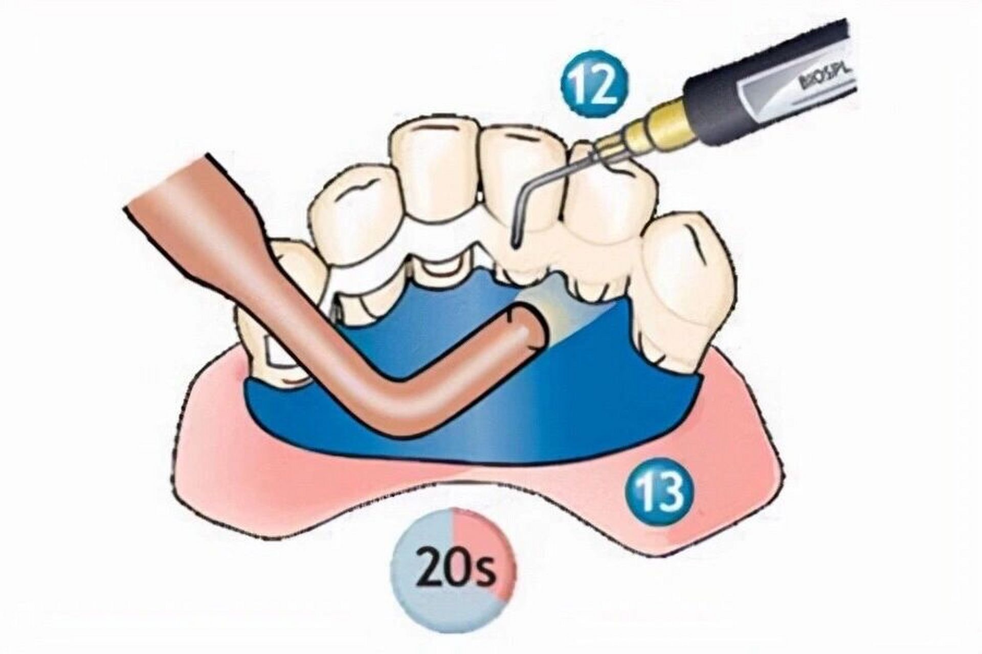 松牙固定术步骤图片