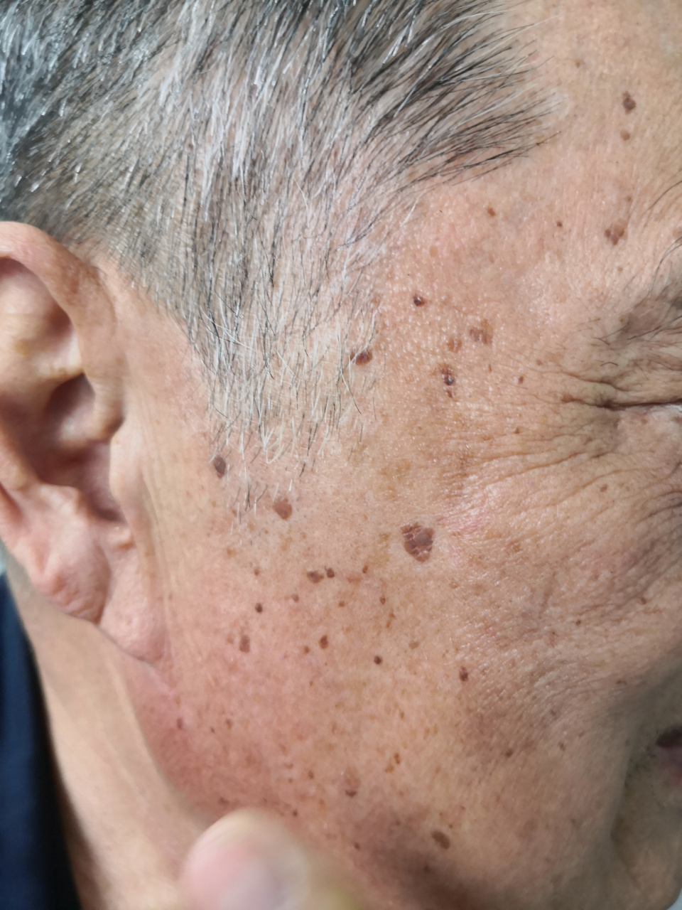 面部老年斑/脂溢性角化眼睑边缘的血管痣症状#美容##激光美容# 可以