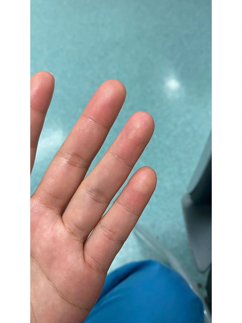 左手无名指和小指,手指头肚上长的白白的,跟个小疙瘩似的,不痛不痒