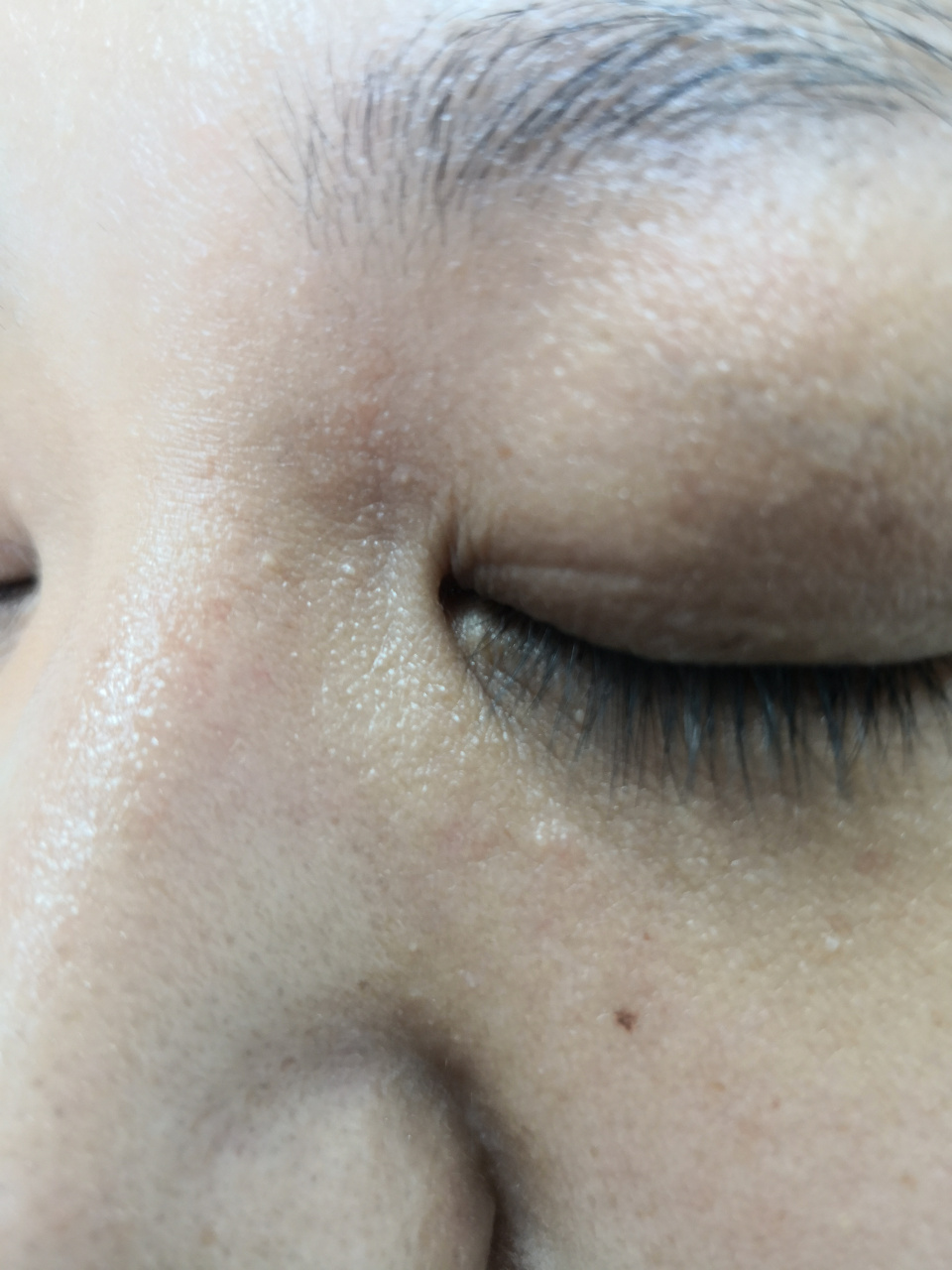 眼睑及周围的粟丘疹和汗管瘤症状#解决皮肤问题专注皮肤美容##激光