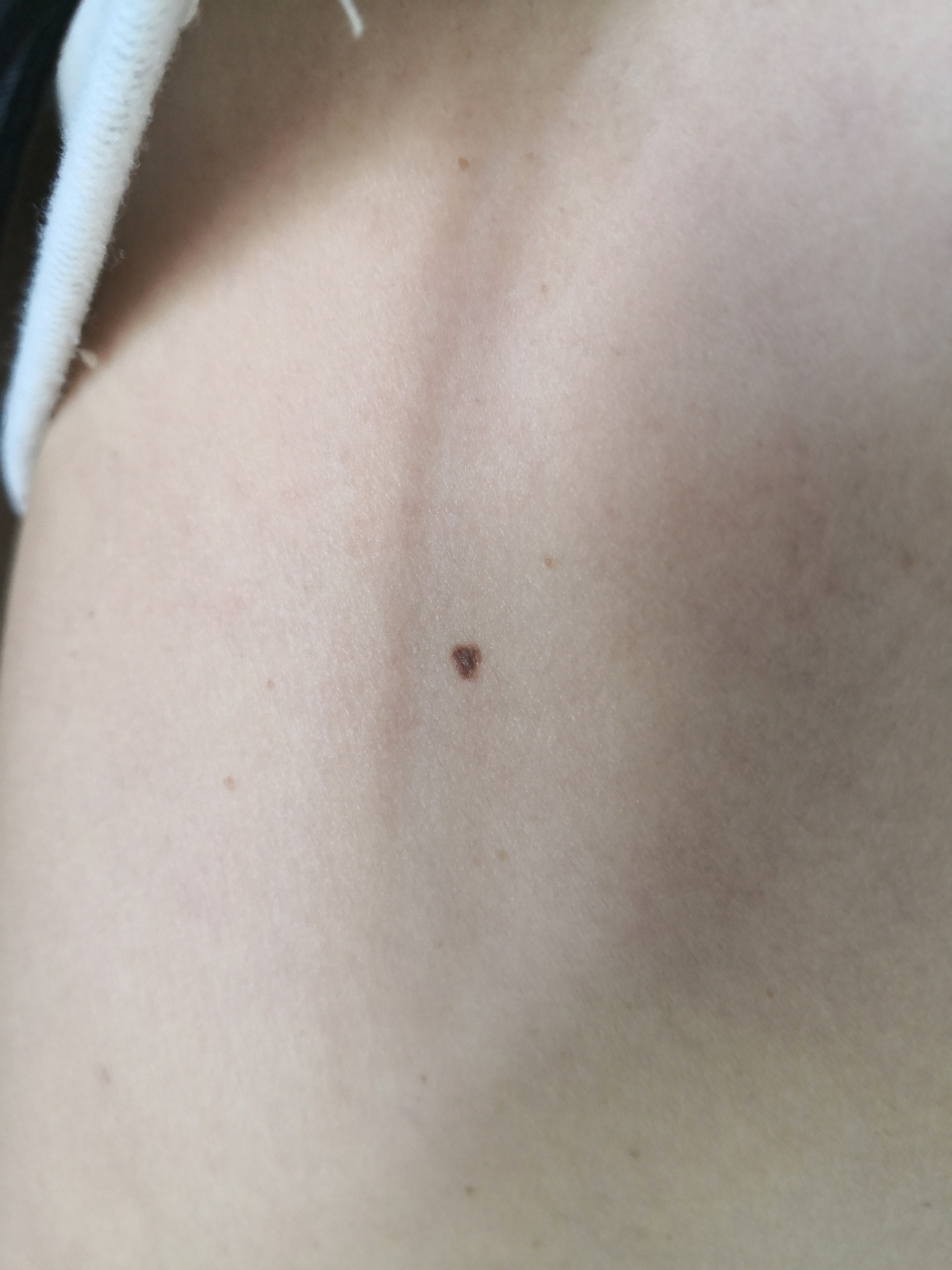 背部老年斑/脂溢性角化症状.#美容##解决皮肤问题专注皮肤美容