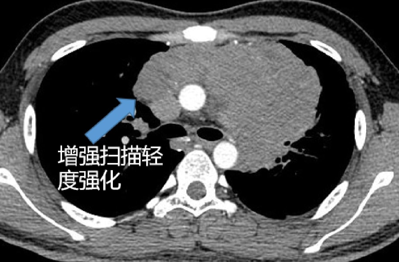 患者,男,17岁,体检发现纵隔占位 前中上纵隔见一团块状软组织密度影