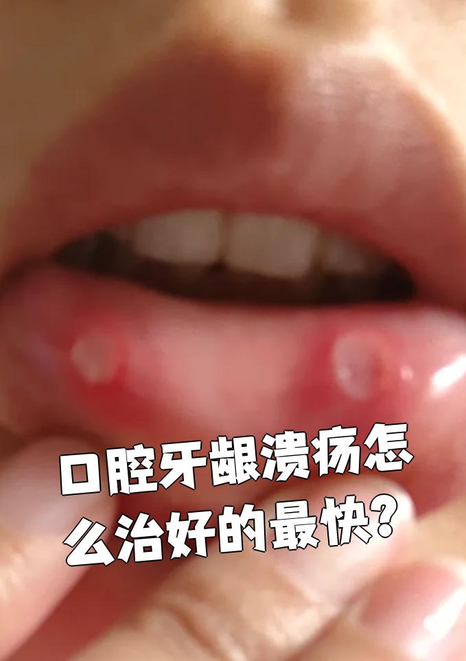 口腔牙龈溃疡想好得快,可以口服药物或者配合局部用药一起治疗