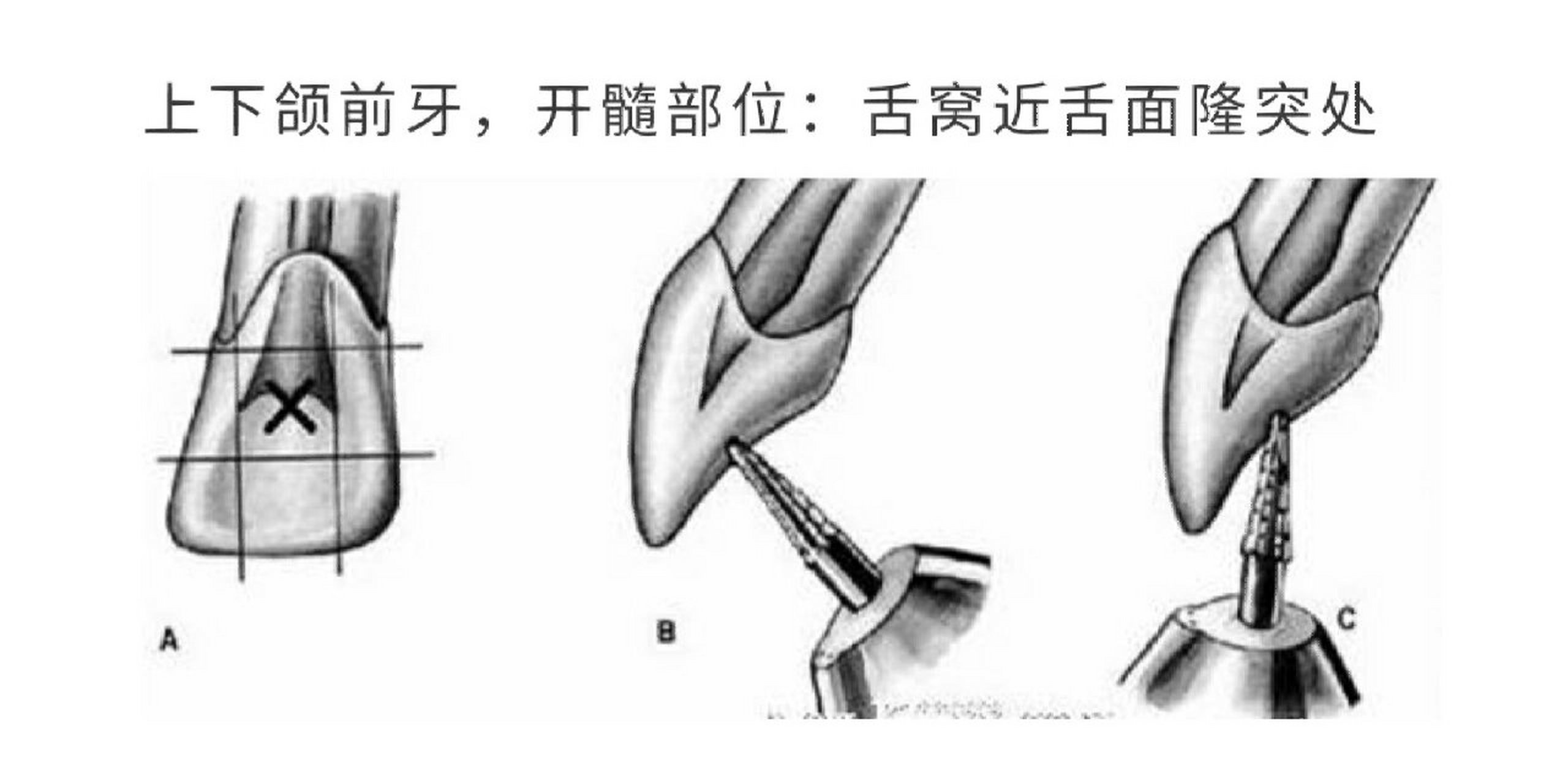 口腔开髓位置图图片