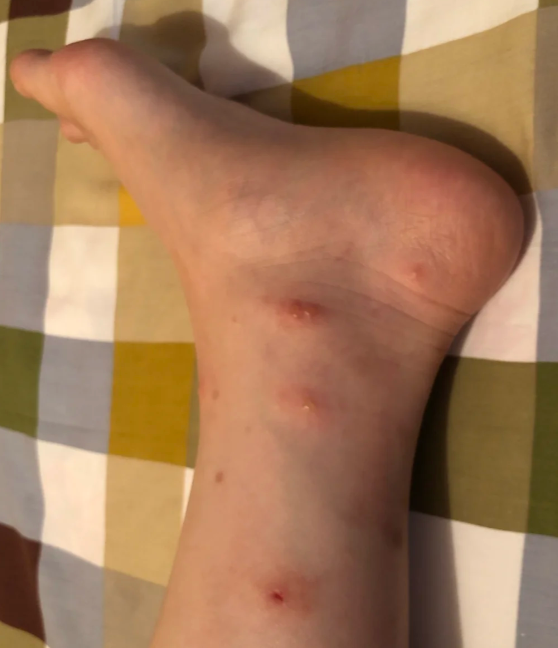 咬人后的皮肤症状图片被虫子咬红肿虫咬了是什么样子图丘疹是怎么回事