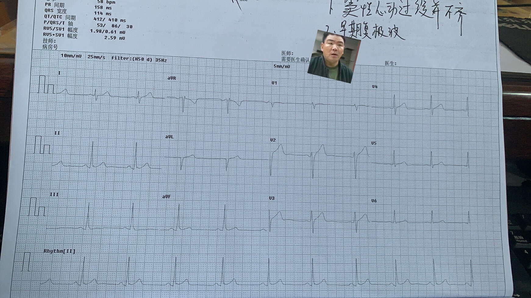 体检医生诊断给的是1:窦性心律过缓并不齐,2:早期复极波, 有大佬帮忙