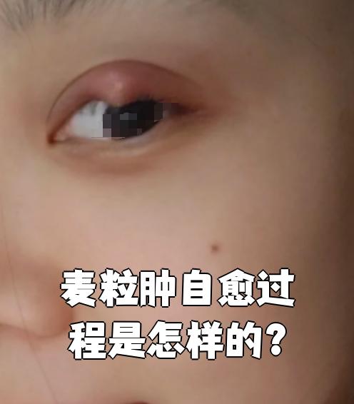 麦粒肿也叫睑腺炎,俗称"针眼"