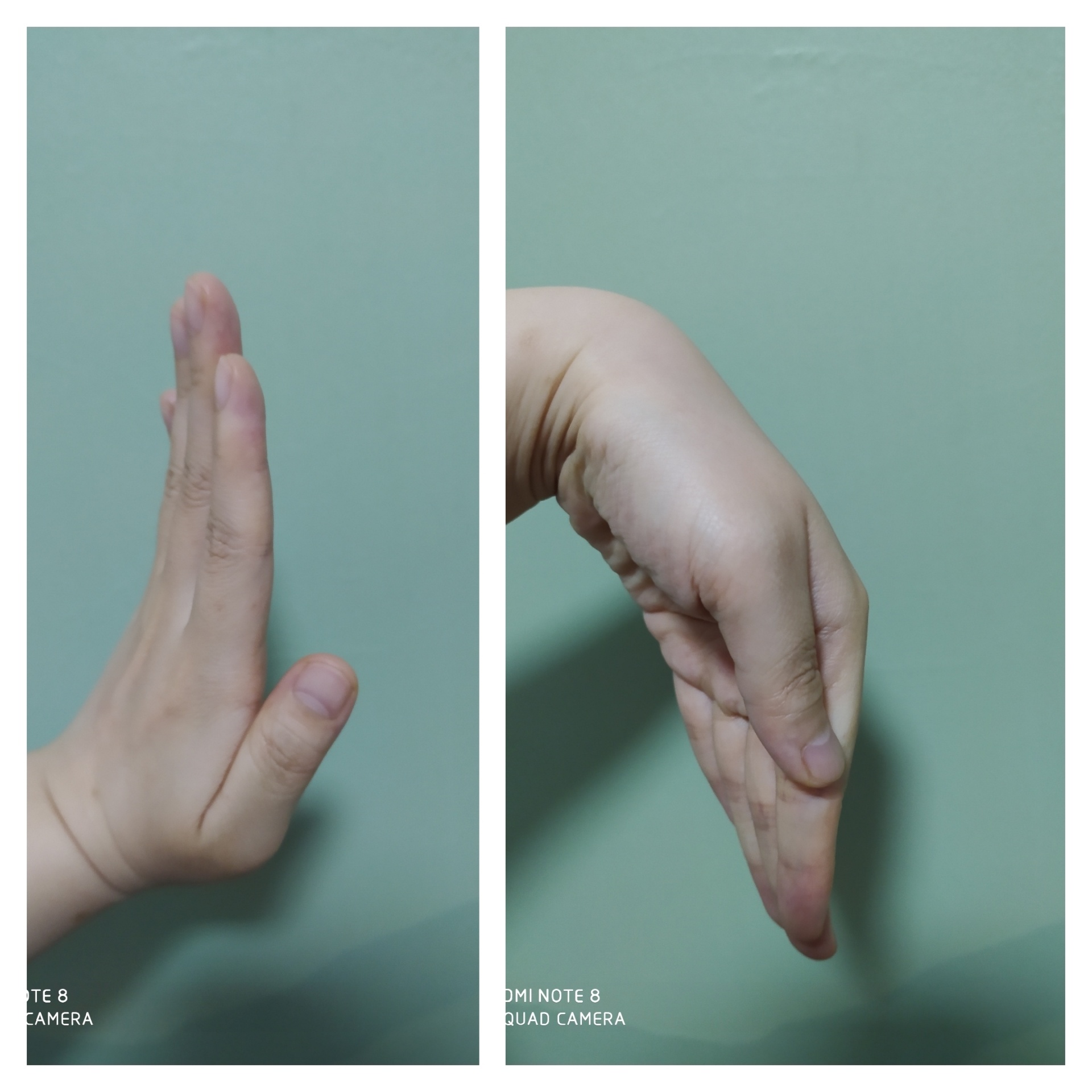 教你3个手指操,缓解类风湿关节痛