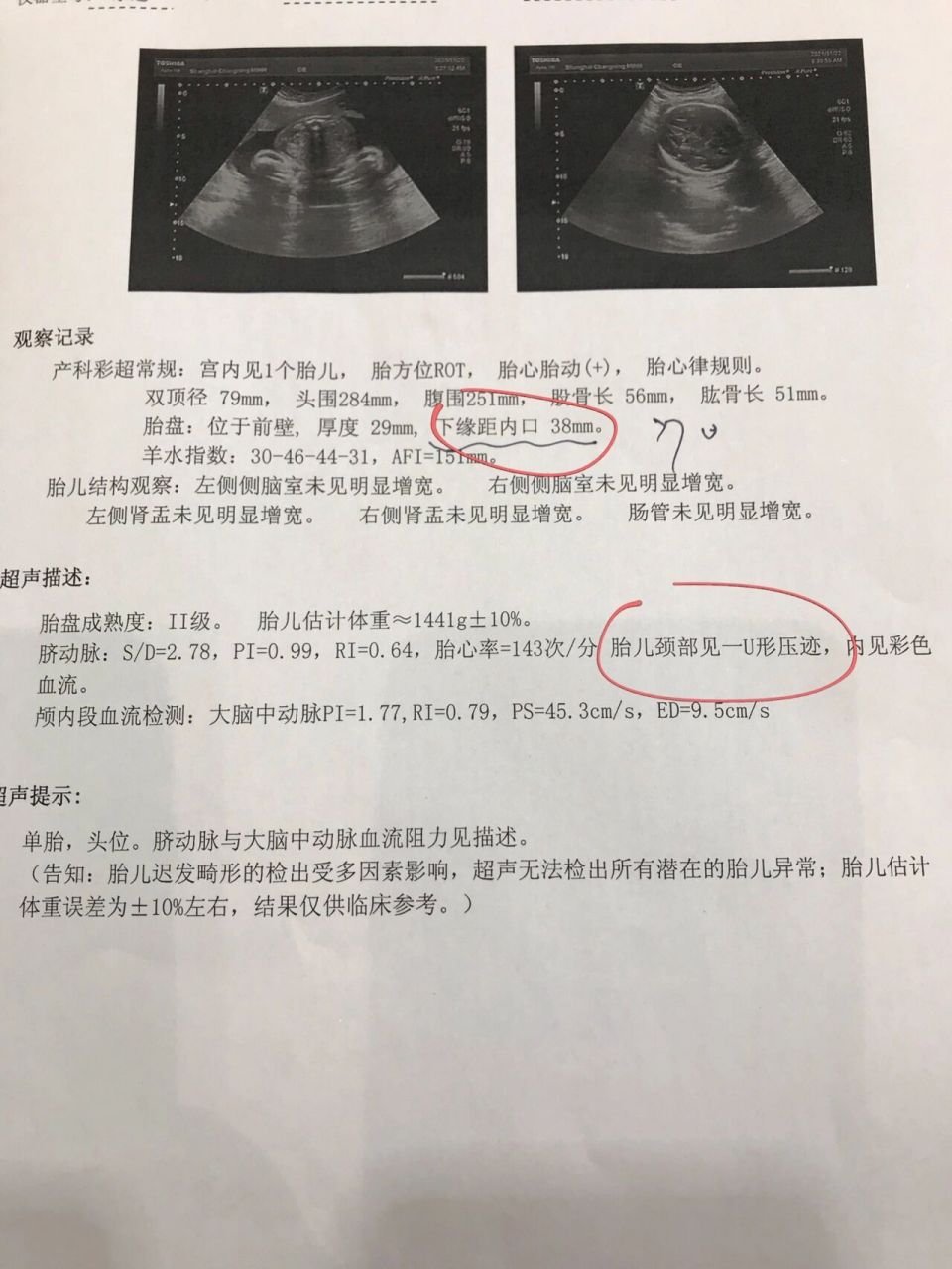 孕31周产检结果宝宝脐带绕颈一周 胎儿脐带绕颈一周, 医生说是小问题