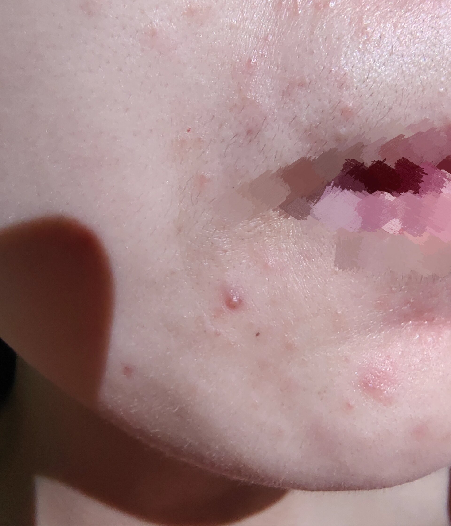 脸上起的小红疙瘩到底是什么呀 嘴边上起的一个小点一个小点的疙瘩,是