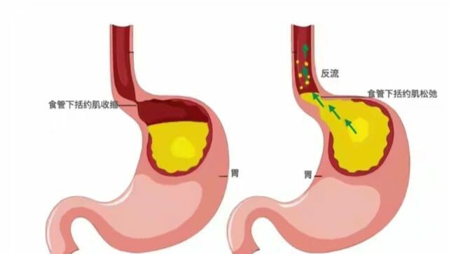 儿童胃食管反流 儿童胃食管反流 胃食管反流是食物和胃向食道,有时向
