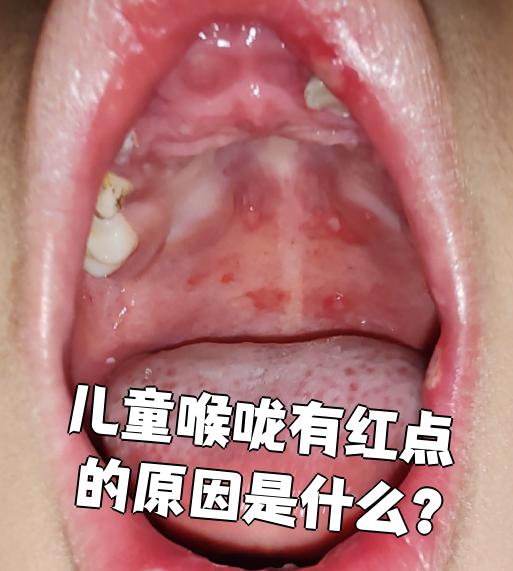 孩子喉咙出现红点,最常见的原因是扁桃体炎,咽炎或手足口病