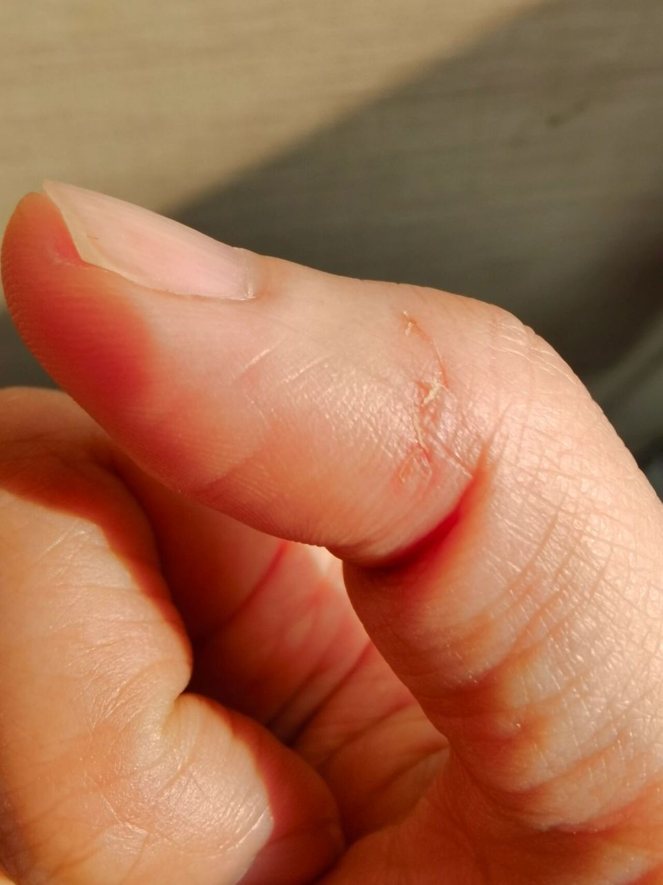 被家养小狗咬伤出血处理 昨天晚上喂小狗的时候不小心被小家伙咬破了