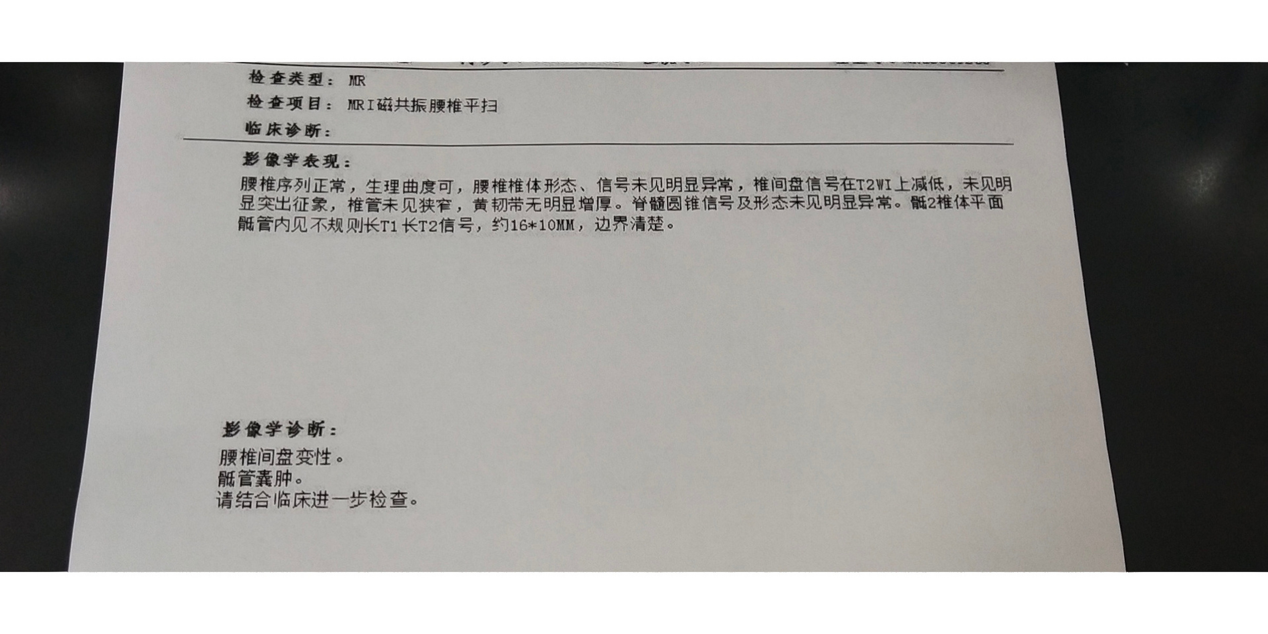 骶管囊腫導致腰疼怎麼辦 腰疼去拍核磁共振,原來是骶管囊腫引起的