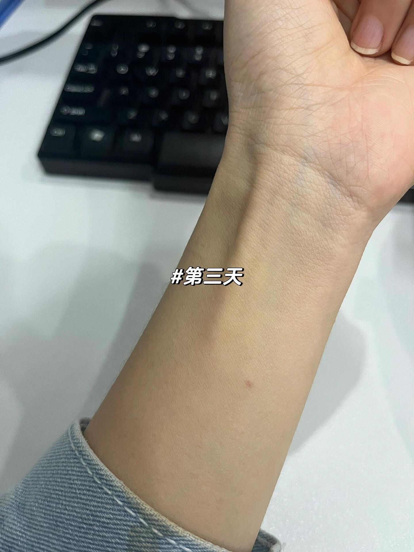 结核皮试检查全过程 挂了医院的结核筛查部门,医生会问你哪里不舒服