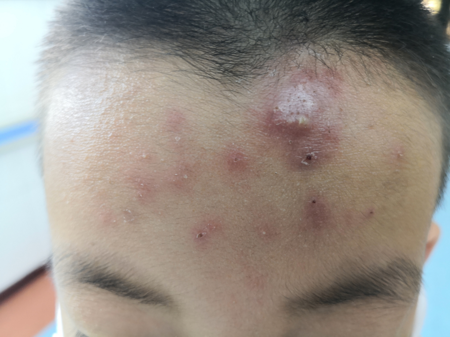 十岁的小男孩额头痤疮症状.