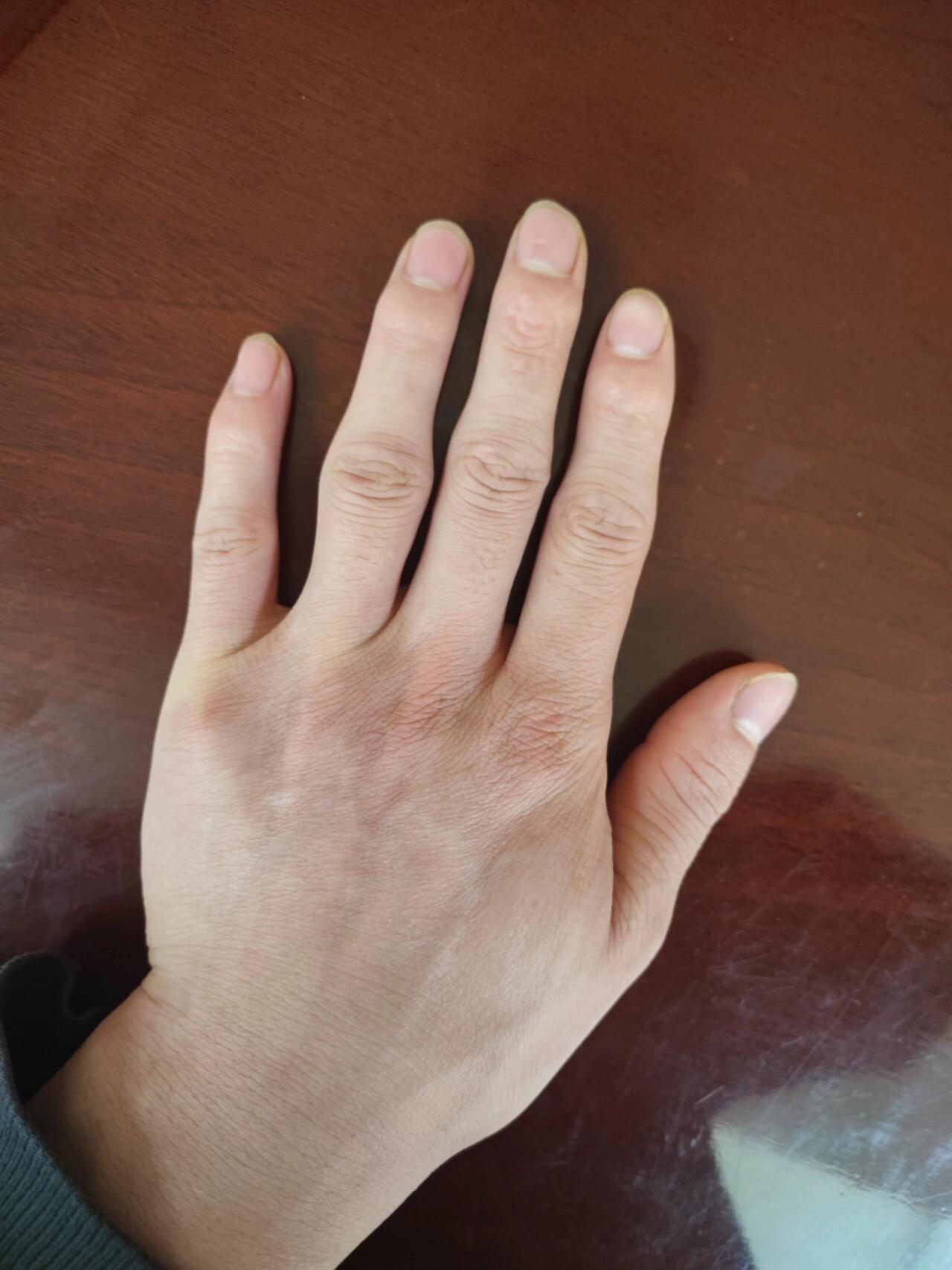 21岁得了关节炎,类风湿,看看你们的手 2021年,1月在新疆哈密,在哈密的