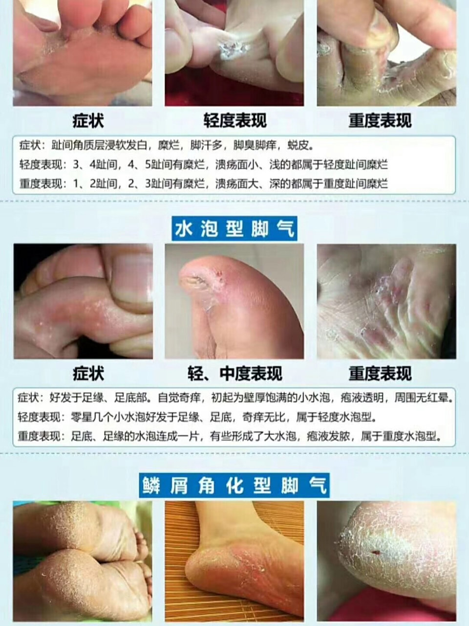 看看这两张图就知道了 不同的脚气类型,治疗方法也不一样,不能一概而