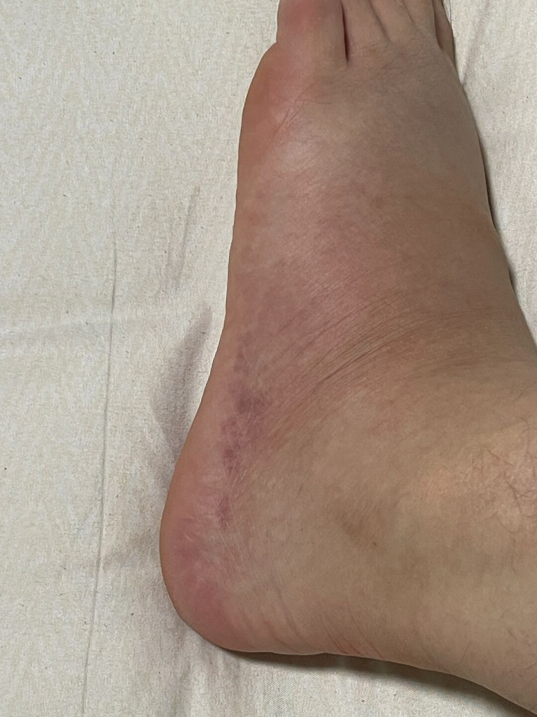 中间只热敷过俩天 今天是崴脚后的第十天,淤青脚肿请假图片崴脚图片