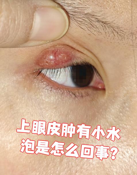 上眼皮肿还长小水泡,常见原因有过敏,麦粒肿和单纯疱疹,不同情况