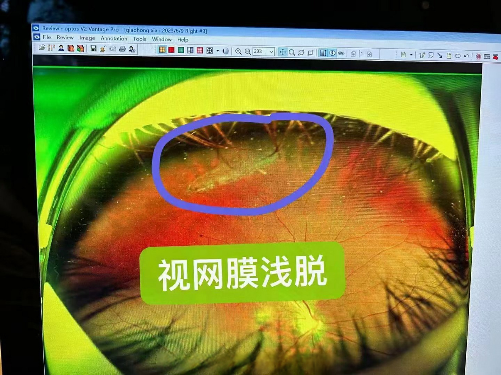 打完眼底激光后封闭变性区 降低视网膜脱落的风险哦#近视手术