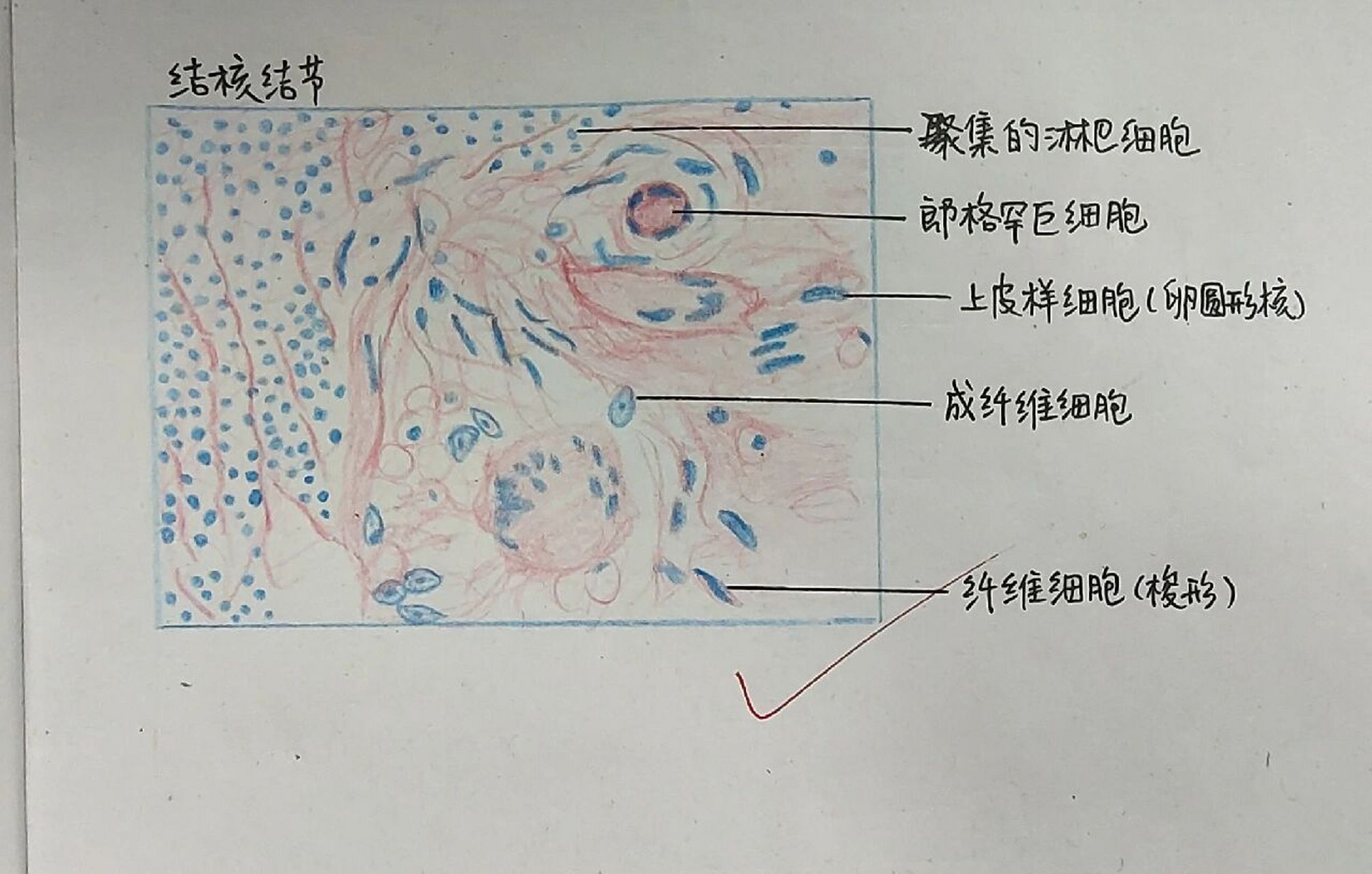淋巴结结核病理手绘图图片