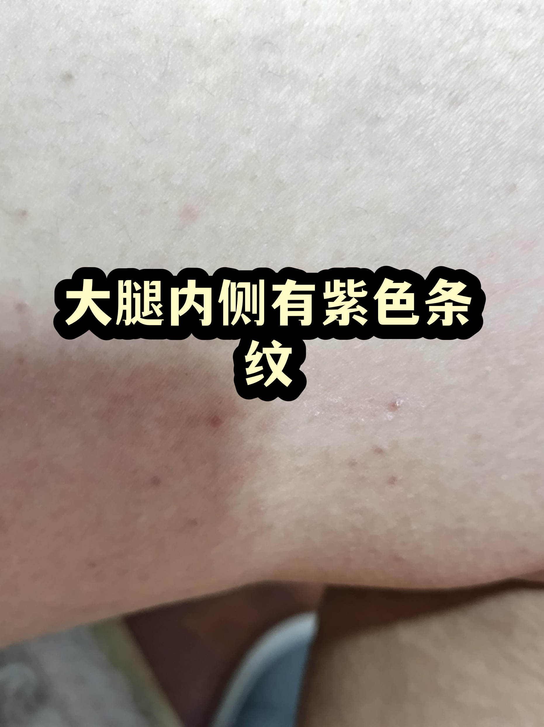 其实这可能是皮肤弹力纤维断裂的表现,通常与体重快速变化,激素水平