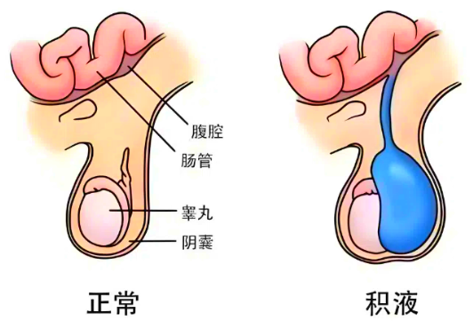 右侧睾丸鞘膜腔积液的治疗方法主要有两种:观察随访和手术治疗