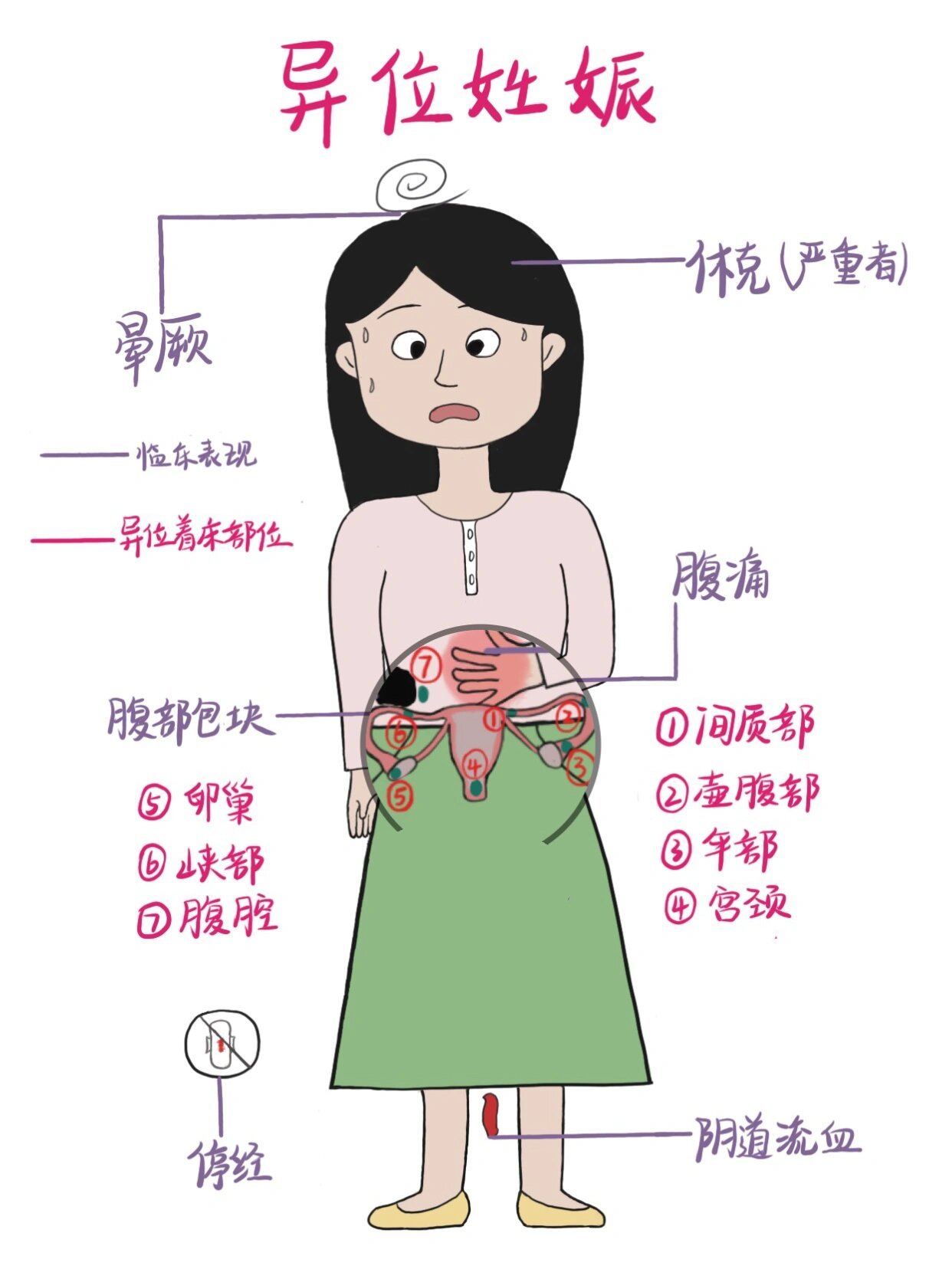 异位妊娠示意图图片