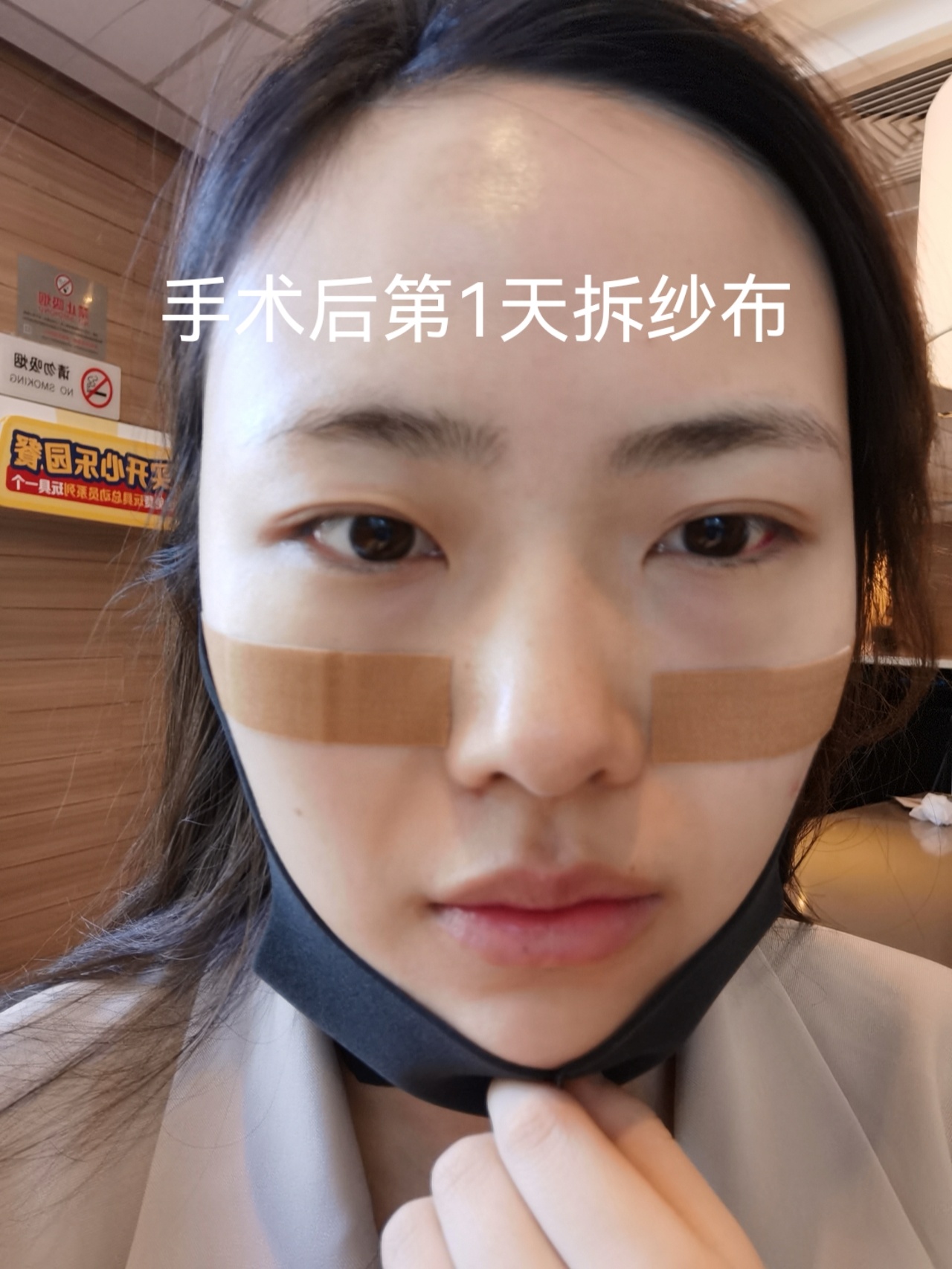 内切眼袋 眶隔释放 术后分享 大家可以看到我眼袋笑起来是很严重的