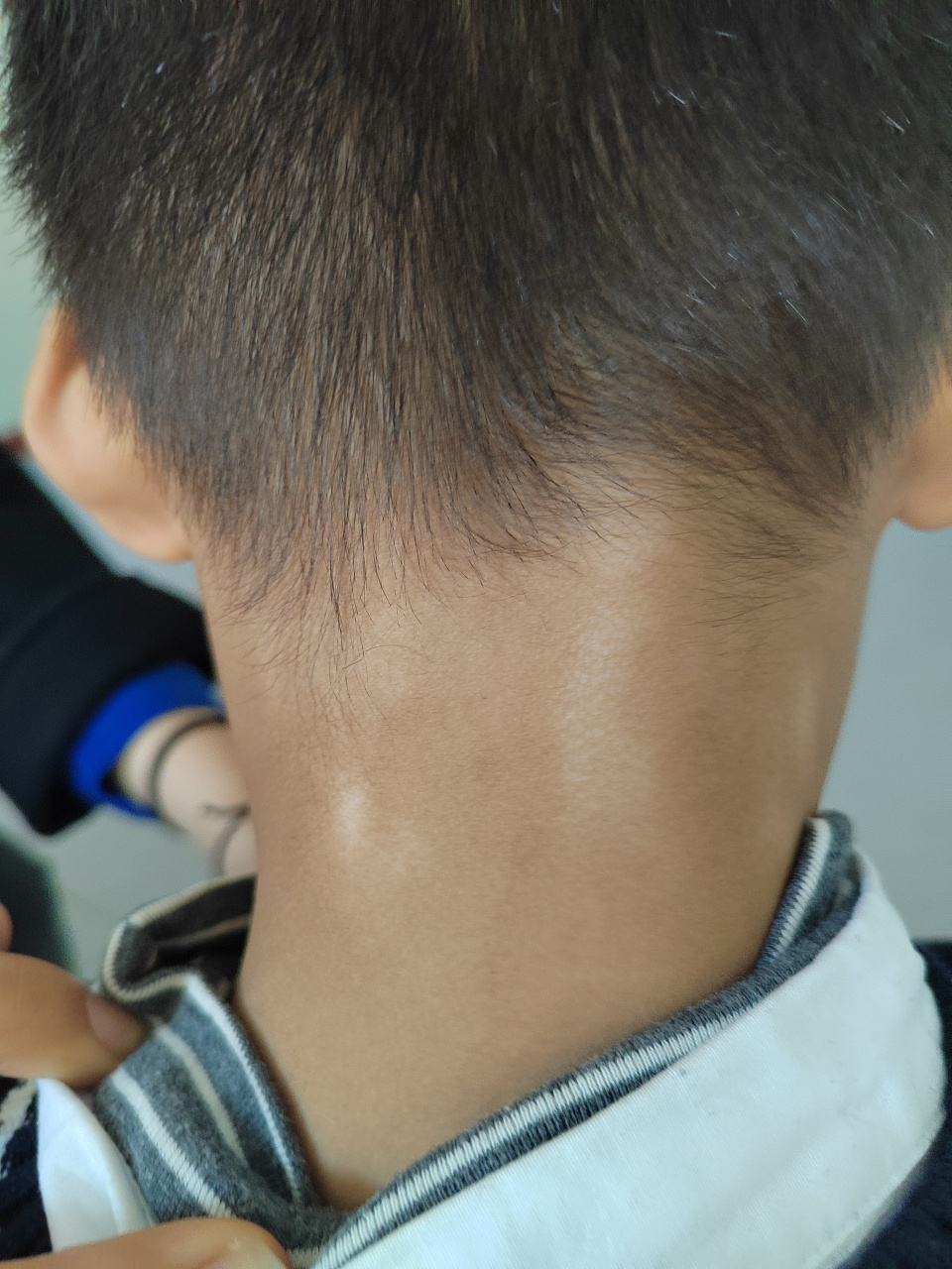 儿童颈部单纯糠疹症状#单纯糠疹