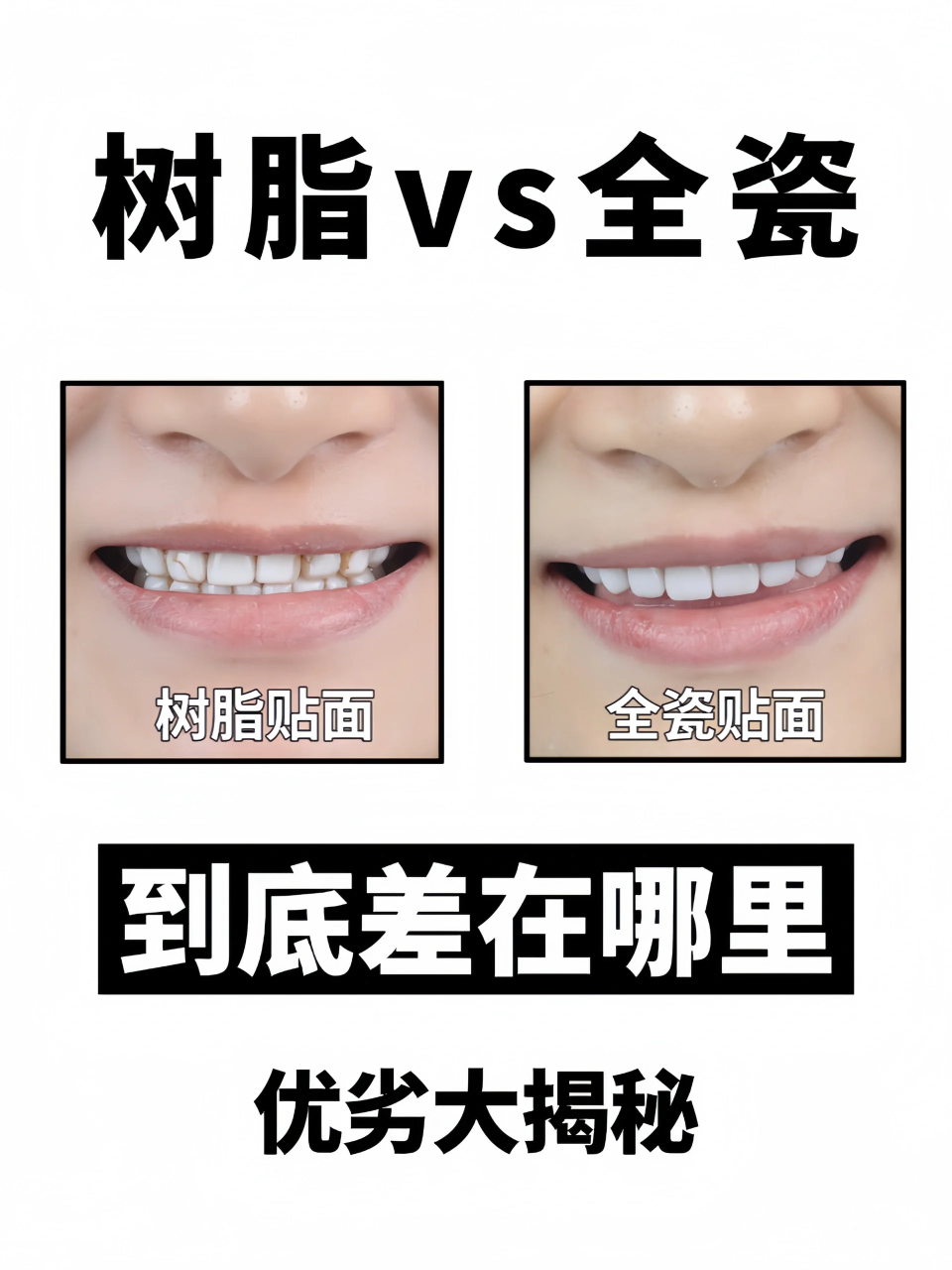 真后悔做了树脂…… 树脂贴面在七八年前十分流行, 很多人因其价格
