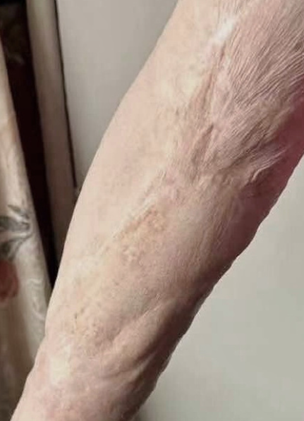 开水烫伤会不会留疤,主要看烫伤的严重程度