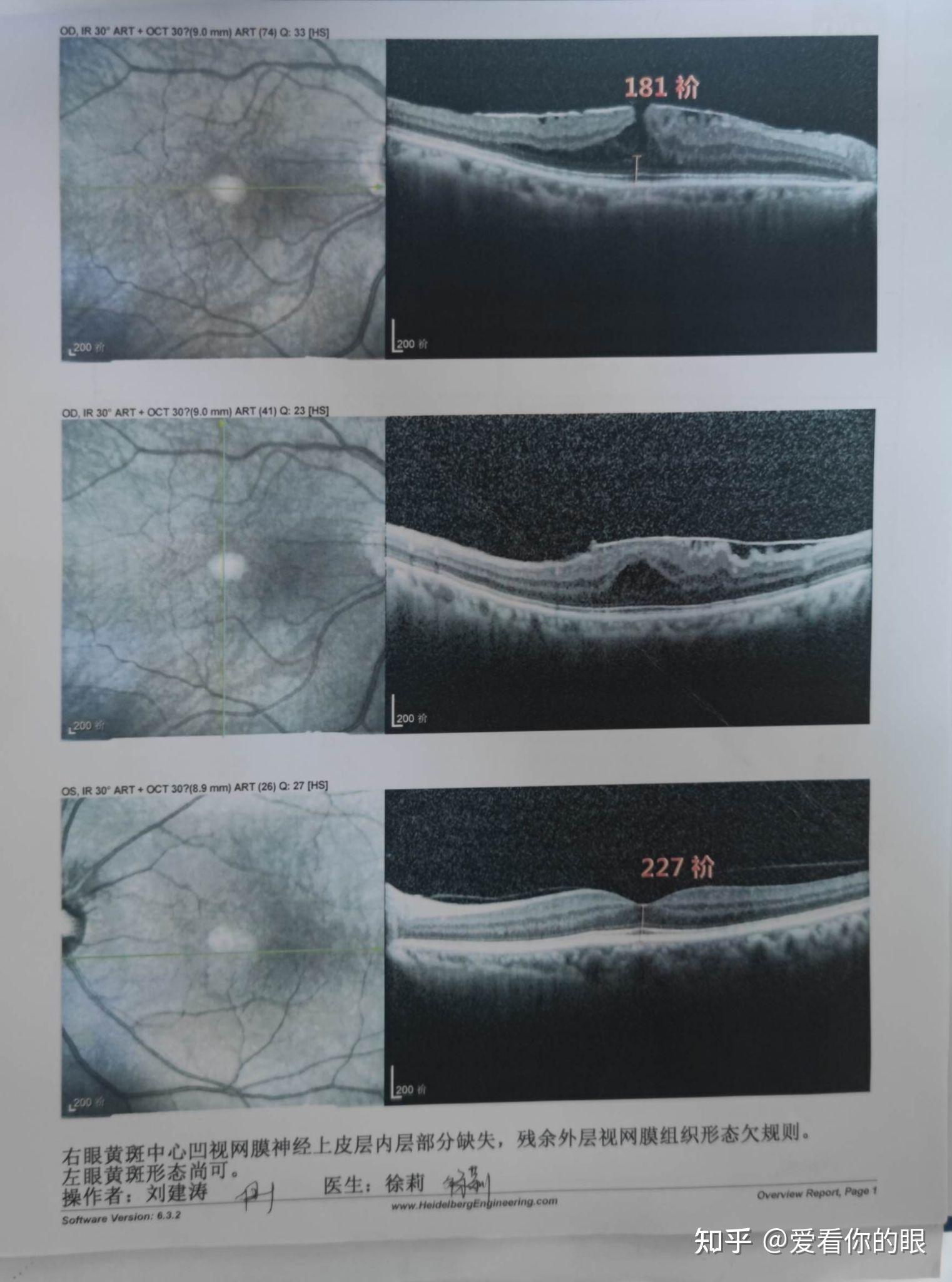 三种常见眼底病黄斑水肿黄斑裂孔黄斑新生血管病变oct检查图示说明