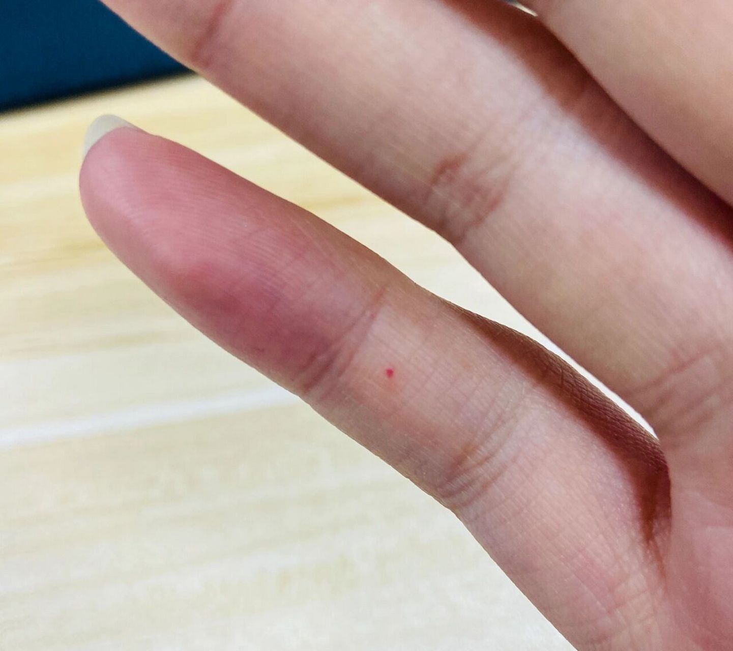 手上长小红点 最初手指长一个小红点,一按就没了,一会儿自己又浮现