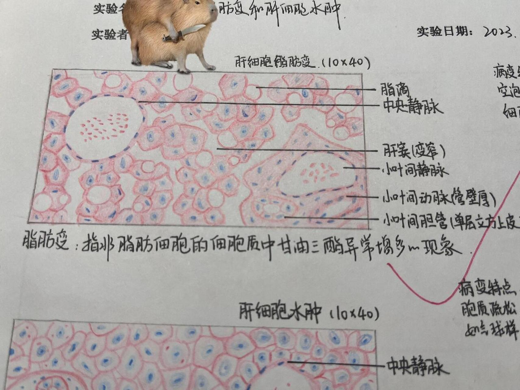 护理学肝细胞红蓝铅笔图 肝细胞脂肪变 肝细胞水肿 正常肝细胞