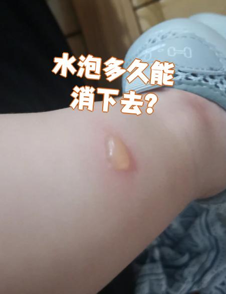 水泡通常需要2到7天才能消退.具体时间要看水泡的原因和大小