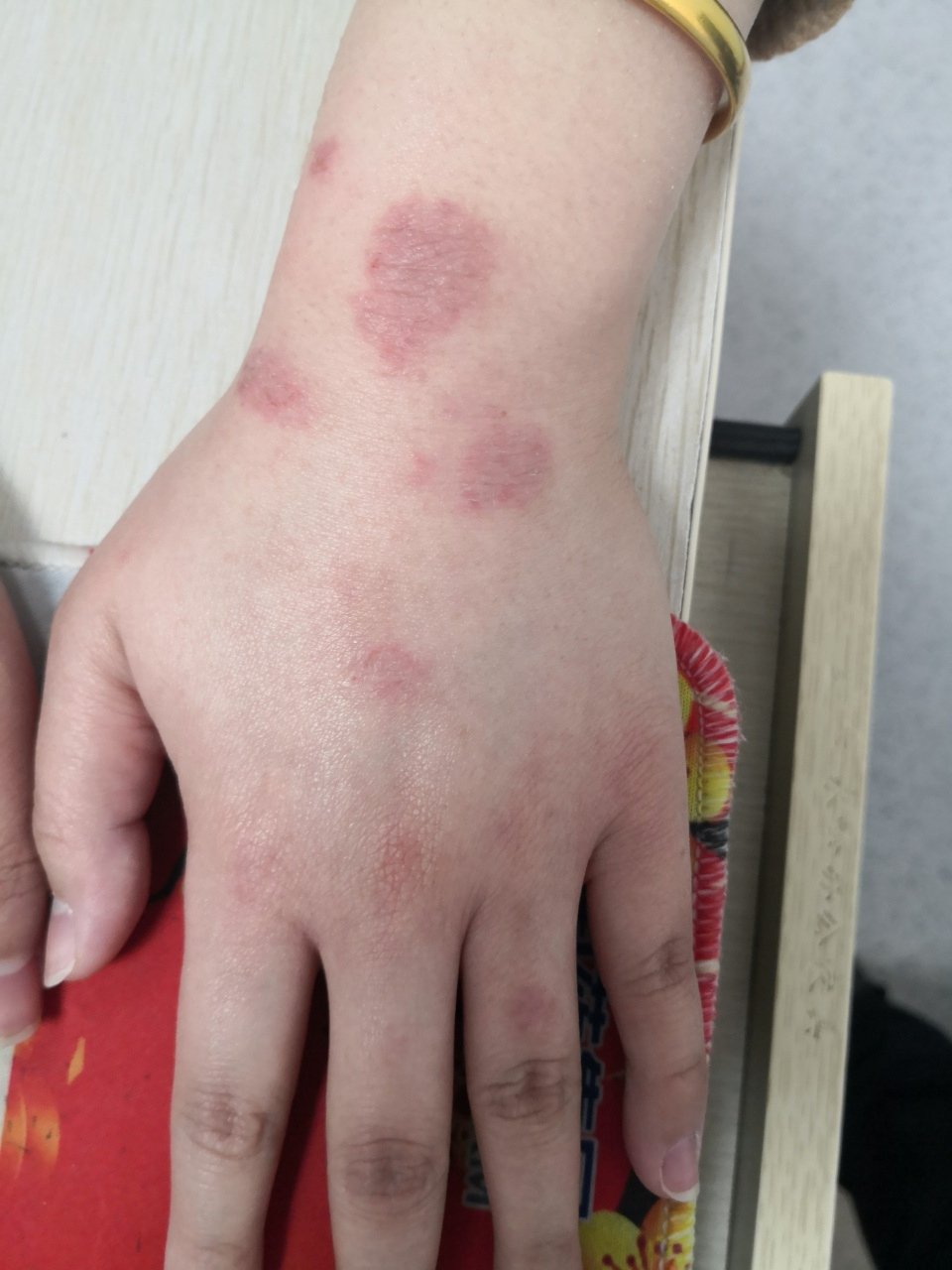 手背红斑斑块症状,是接触性皮炎症状!