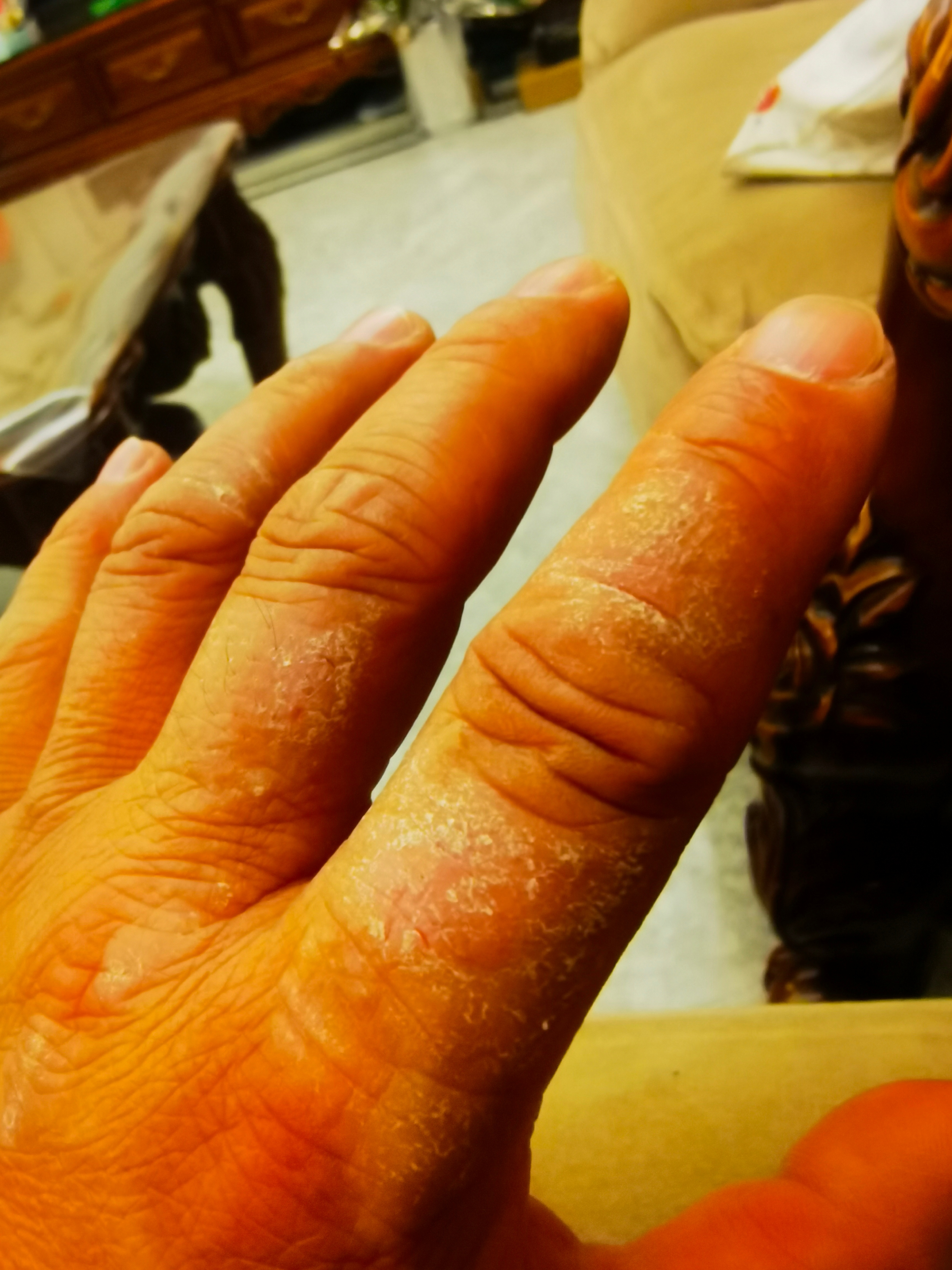 手背干燥脱屑肥厚.特应性皮炎症状.#特应性皮炎