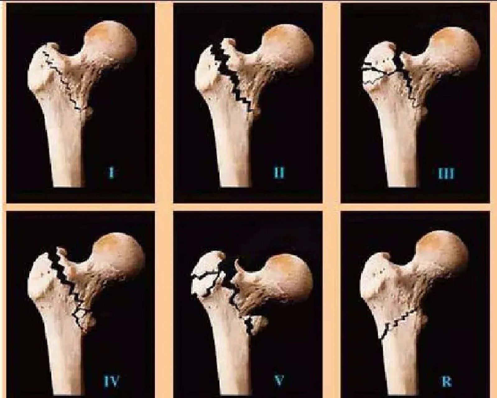 股骨骨折分型图解图片