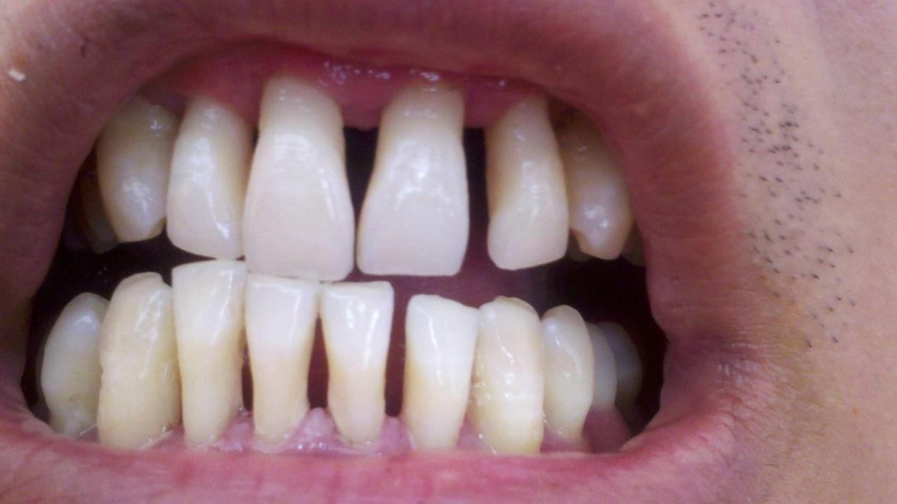 牙缝变大或许是牙周炎所致学会4招帮你解决问题远离牙齿松动