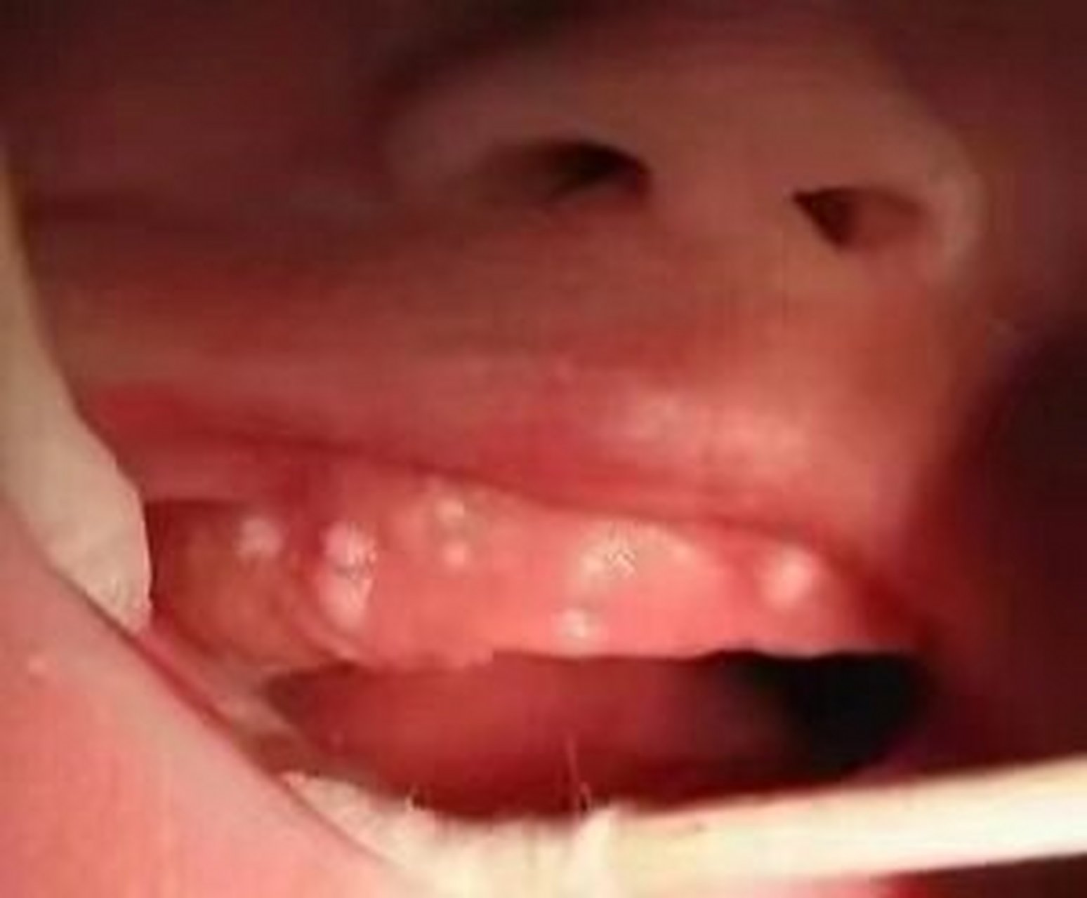 婴儿口腔内有白点(马牙,上皮珠) 婴儿口腔内有白点(马牙,上皮珠) 图1