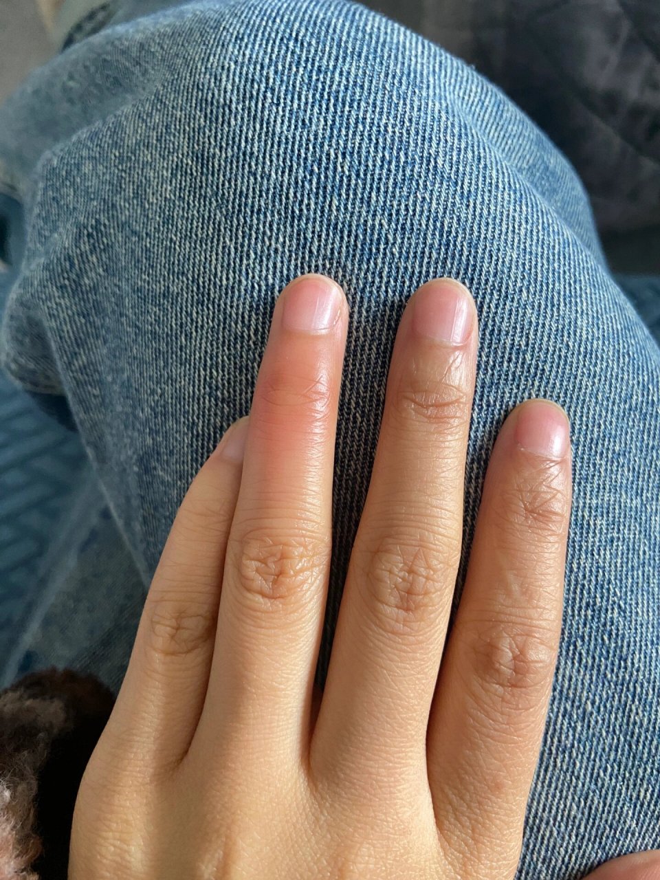 手指这两个关节突然又肿又痒 这是怎么了