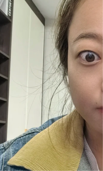 甲亢患者的面容表现主要有消瘦,苍老和眼球突出