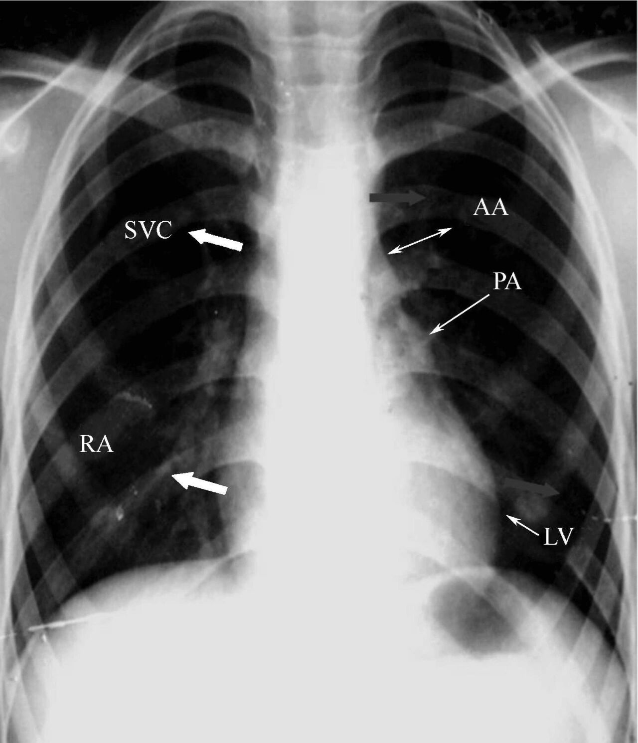x线读片指南(1) 正常心脏x线摄片各体位影像特点 (图1)svc—上腔静脉