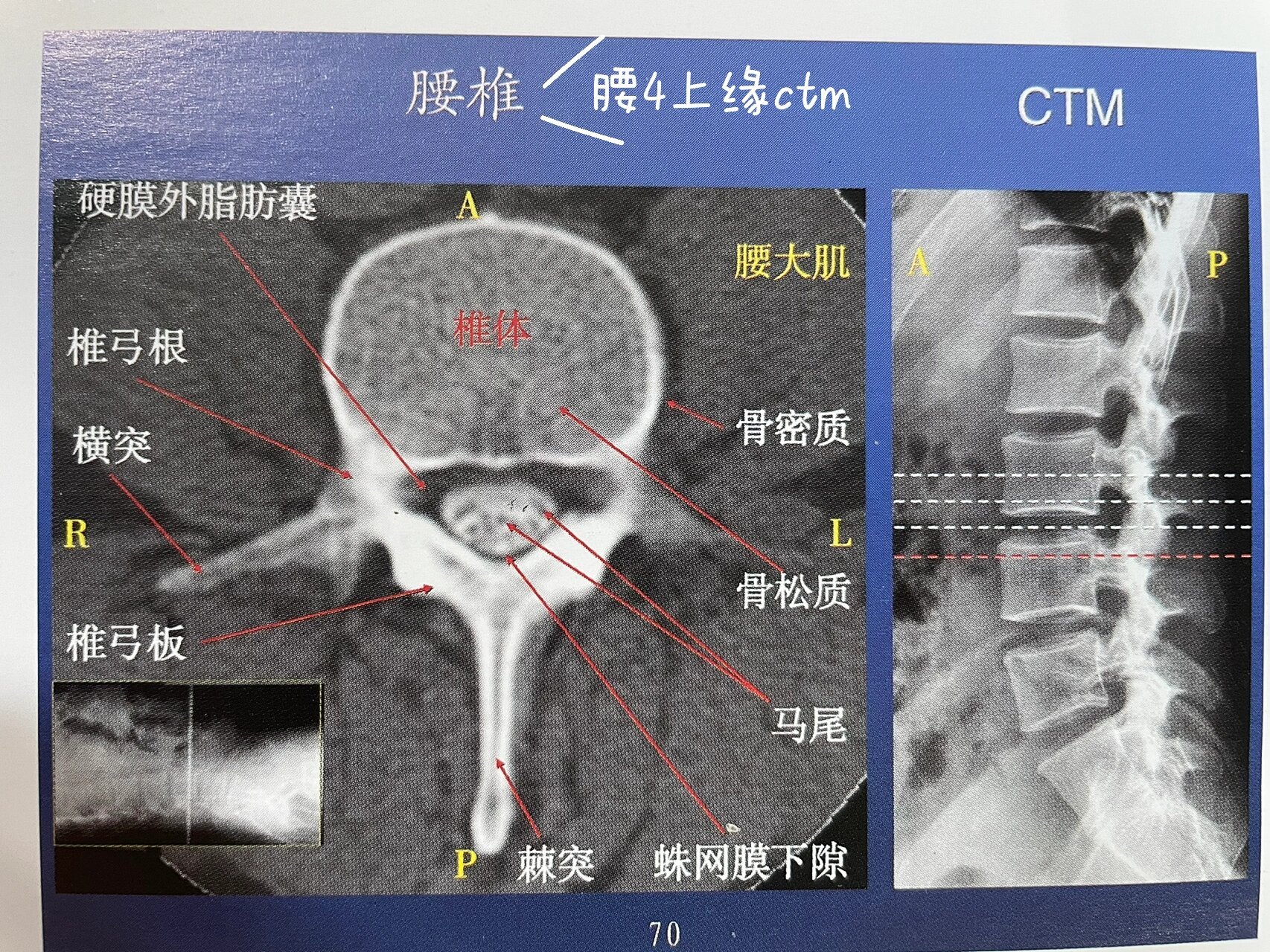腰椎(椎间盘)横断面ct解剖 平行于椎体终板作腰椎横断ct扫描,正常腰椎