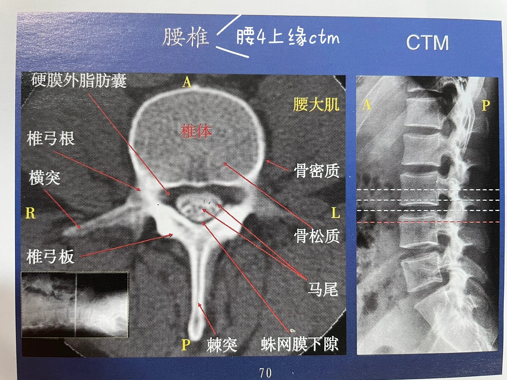 腰椎终板图片