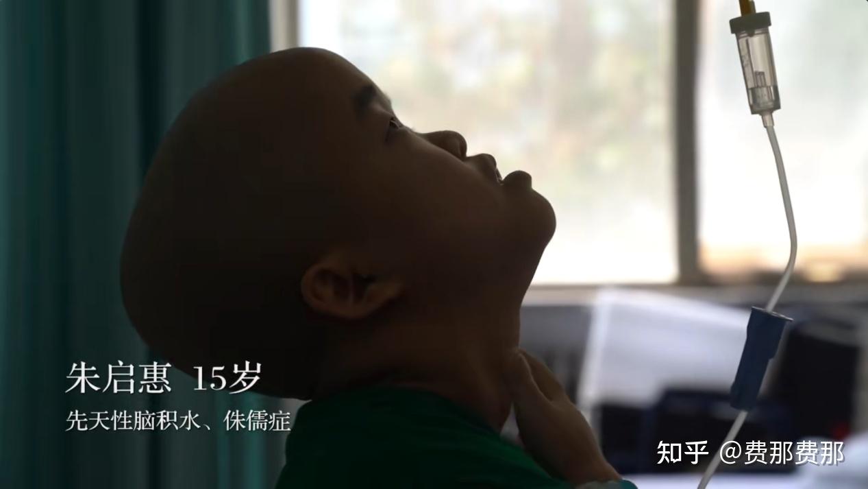 大头娃娃艰难求医路一例特殊的先天性脑积水补救性治疗