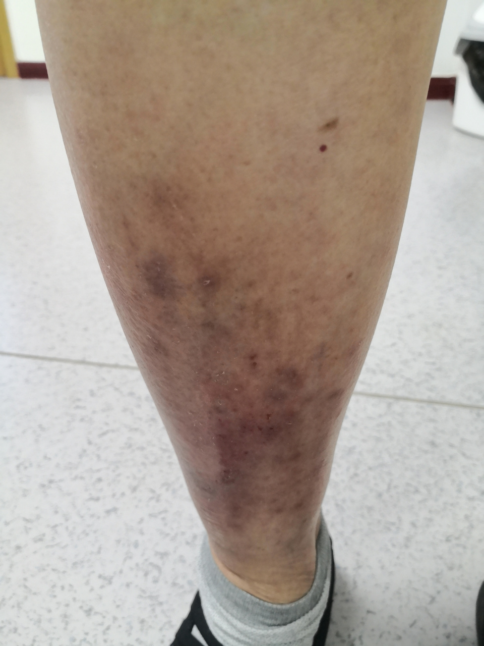 小腿湿疹症状,考虑下肢静脉曲张导致的淤积性皮炎